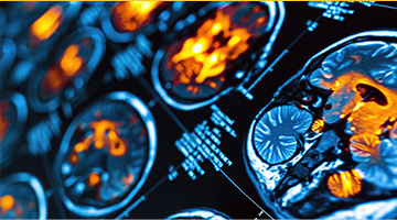 High resolution PET CT scan of the human brain